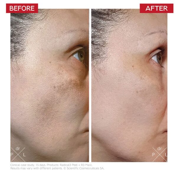 Dr LEVY Radical3 Reboot Pro Peel - Image 4